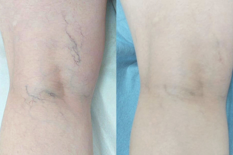 Сосудистых звездочки на ногах: когда необходимо лечение 